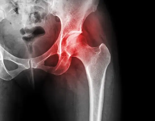 Hip Pain Skeleton X-Ray Hip Pain Skeleton X-Ray