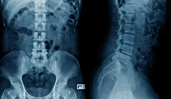 Spine Care Skeleton X-Ray Spine Care Skeleton X-Ray